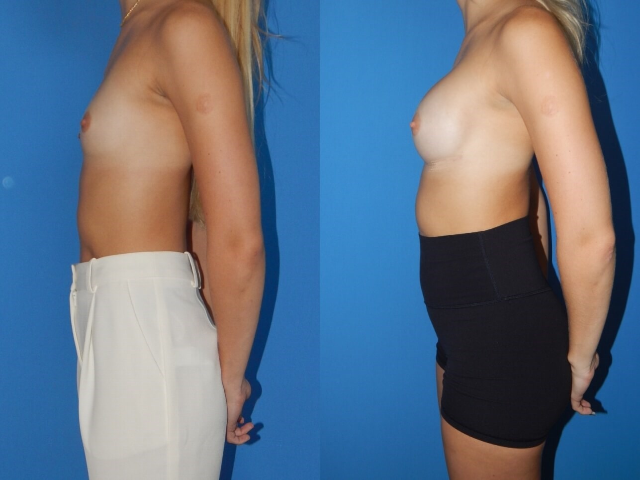 Breast Augmentation Miami Before
