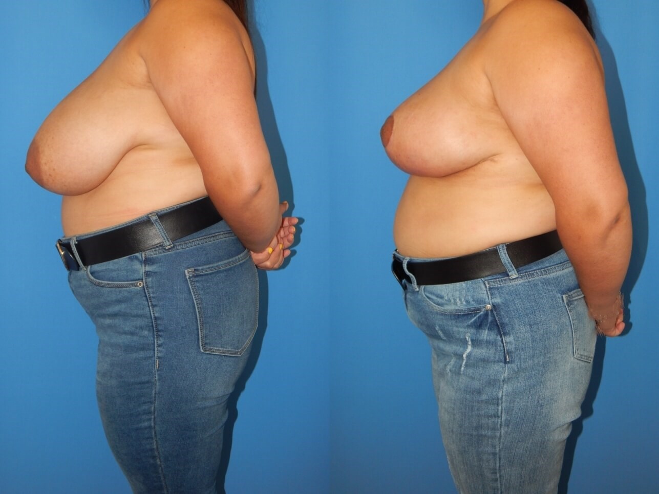 Breast Reduction Before