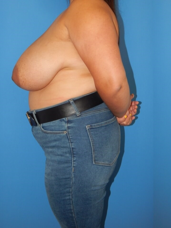 Breast Reduction Before