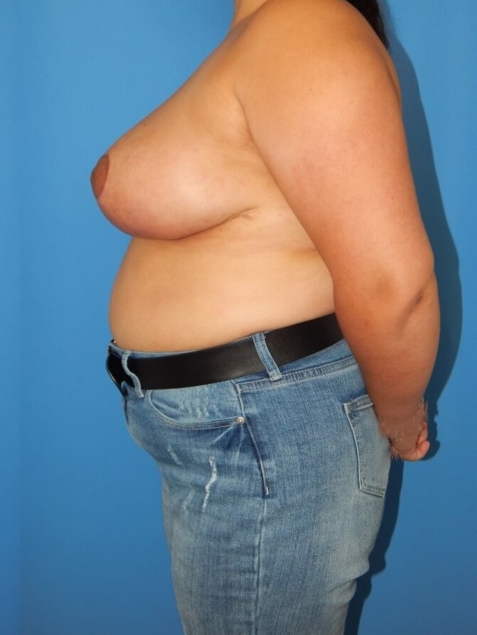 Breast Reduction After