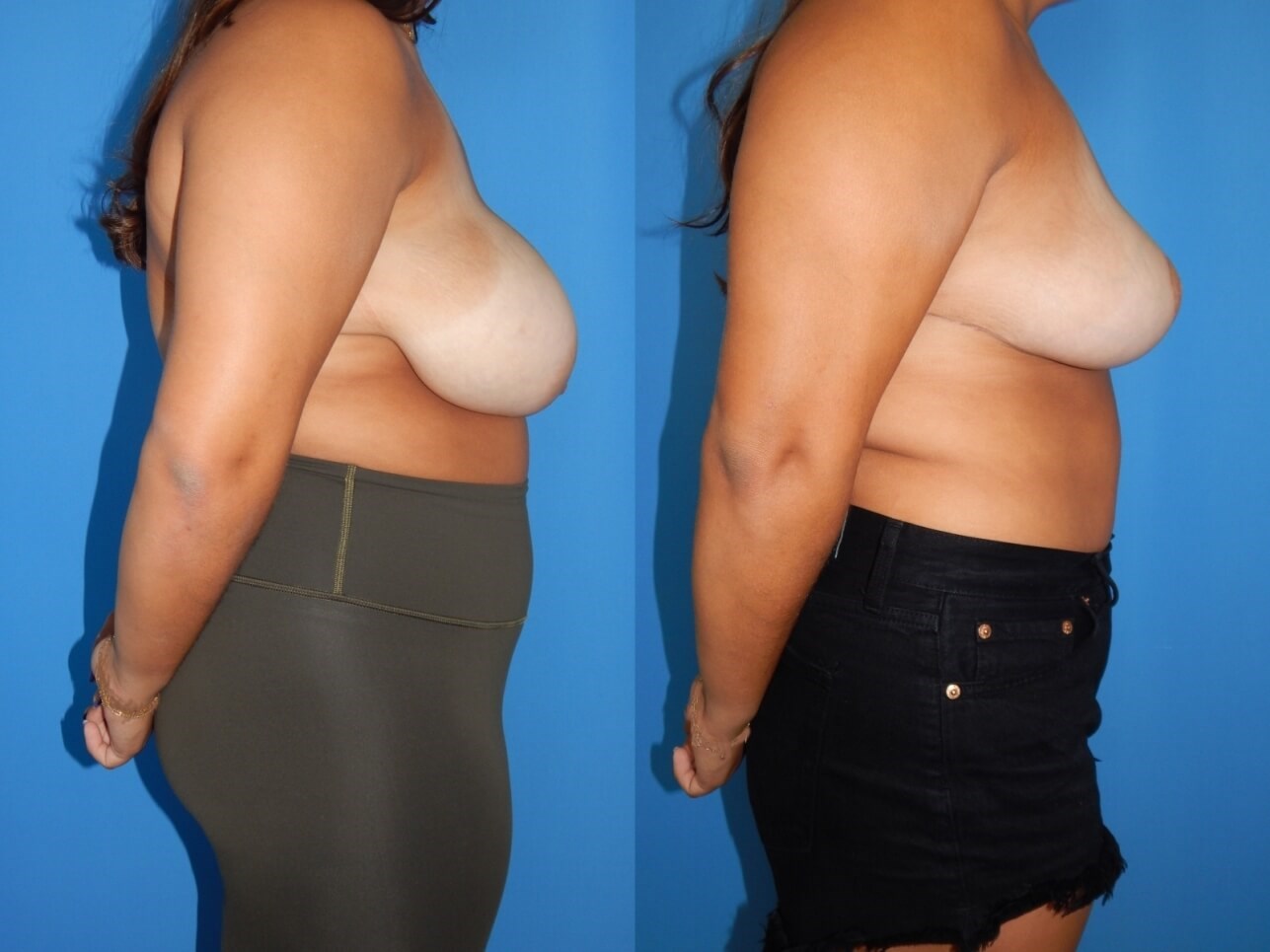 Breast Reduction Asymmetry Before
