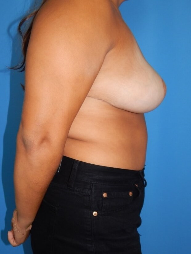 Breast Reduction Asymmetry After
