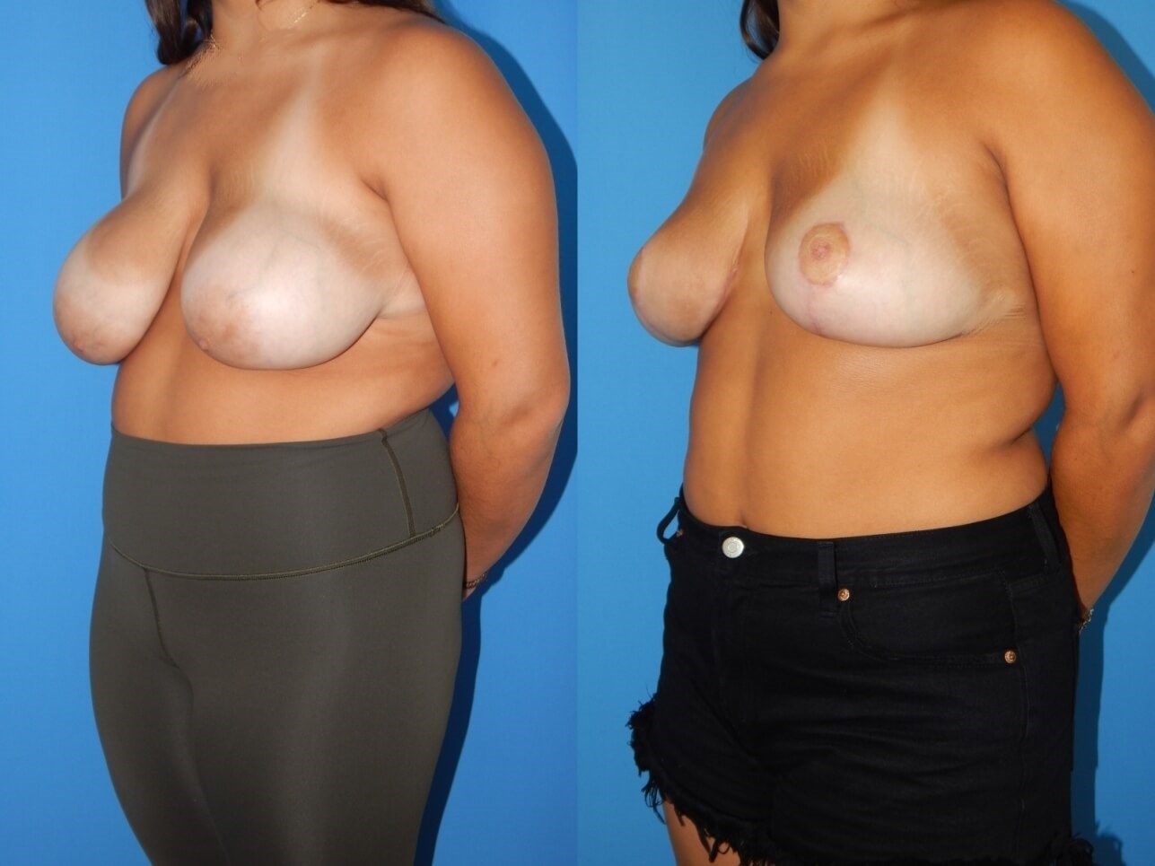 Breast Reduction Miami Beach Before